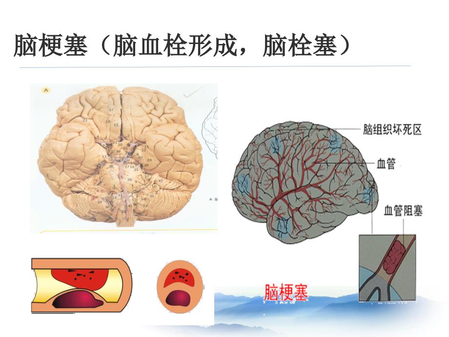 脑卒中的预防课件_第3页