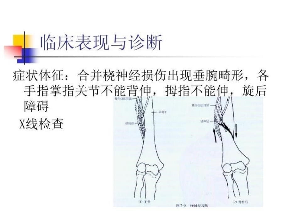 最新四肢骨折病人的护理PPT课件_第5页