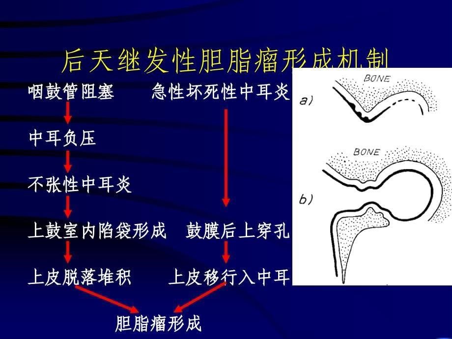 慢化脓中炎ChronicsuppurativeotitismediaP_第5页