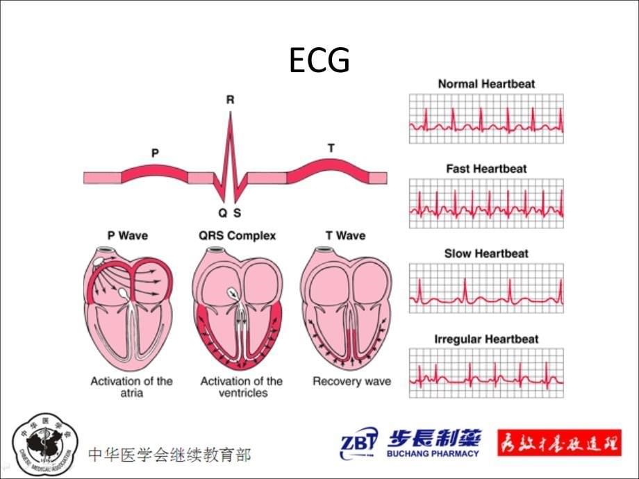 心律失常的诊治_第5页