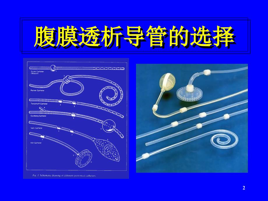 腹膜透析置管术优秀课件_第2页