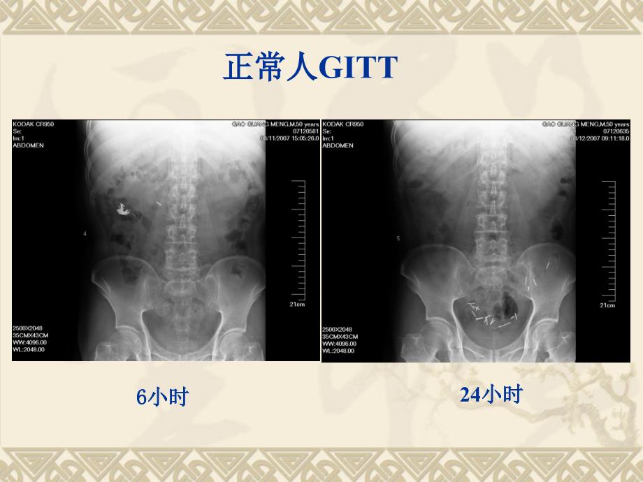 慢性便秘外科治疗ppt课件_第4页