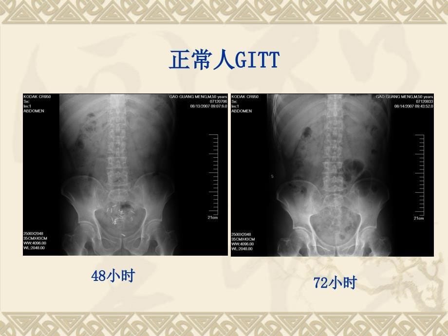 慢性便秘外科治疗ppt课件_第5页