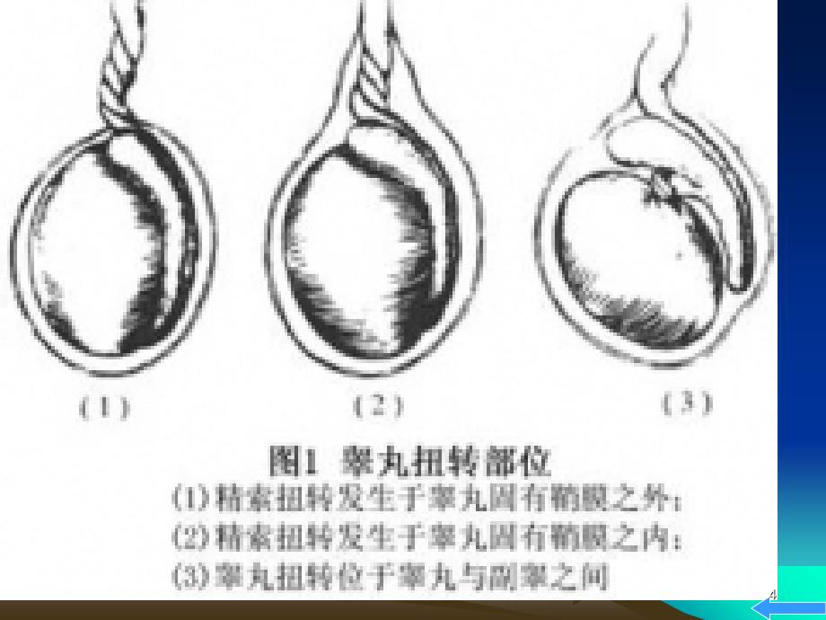 睾丸扭转PPT精品文档_第4页