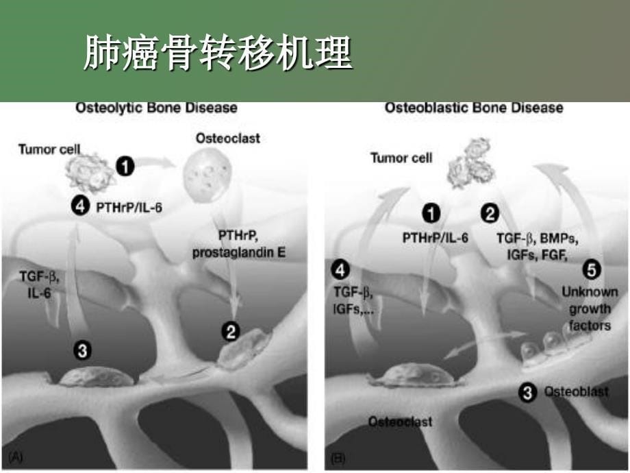 肺癌骨转移治疗_第5页