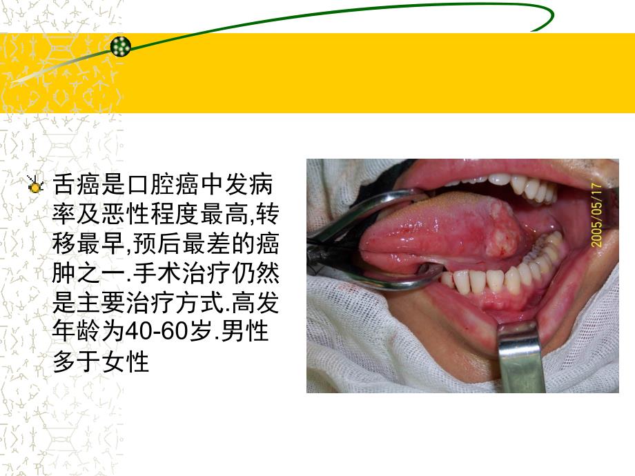 常见三种舌癌手术方式1课件_第3页