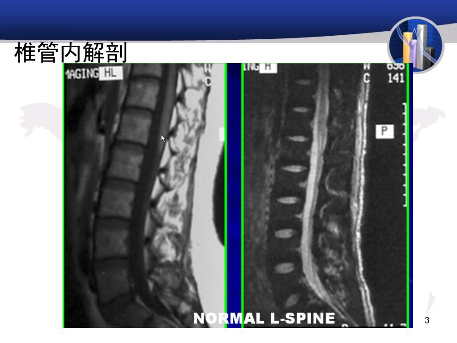 推荐精选脊髓和椎管内病变_第3页