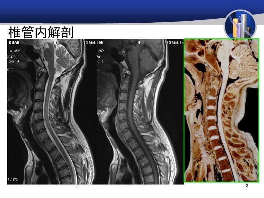 推荐精选脊髓和椎管内病变_第5页