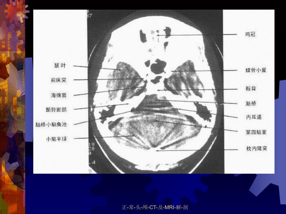 正-常-头-颅-CT-及-MRI-解-剖课件_第3页