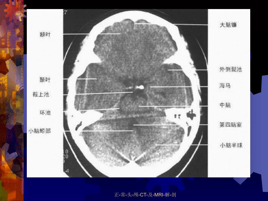 正-常-头-颅-CT-及-MRI-解-剖课件_第4页