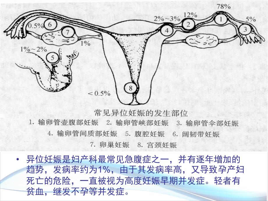 异位妊娠的护理小讲课.ppt_第4页