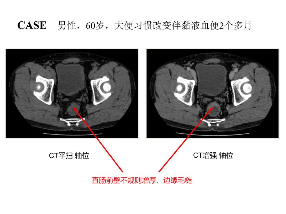 高分辨MRI在直肠癌中应用实例课件_第3页