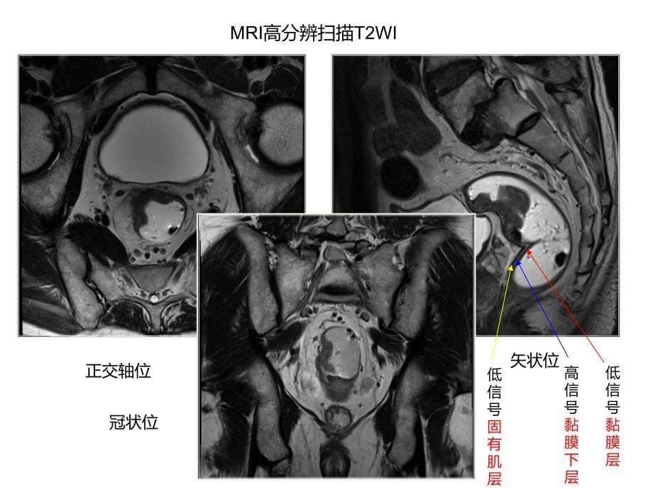 高分辨MRI在直肠癌中应用实例课件_第5页