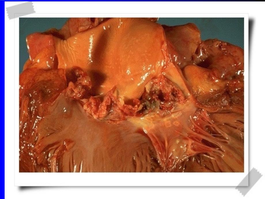 IE感染性心内膜炎_第3页