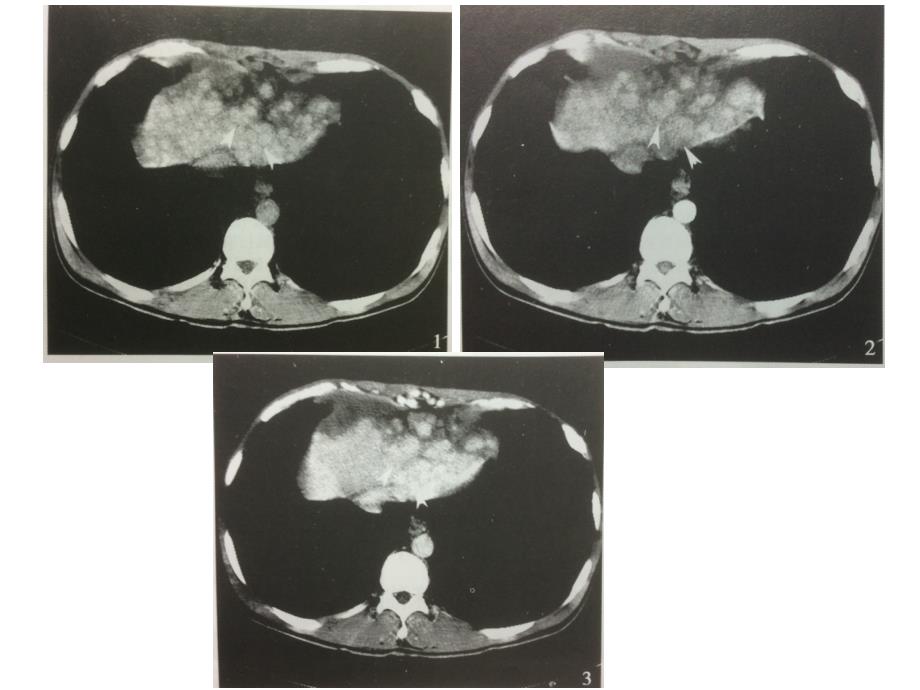 肝癌影像学鉴别诊断_第3页