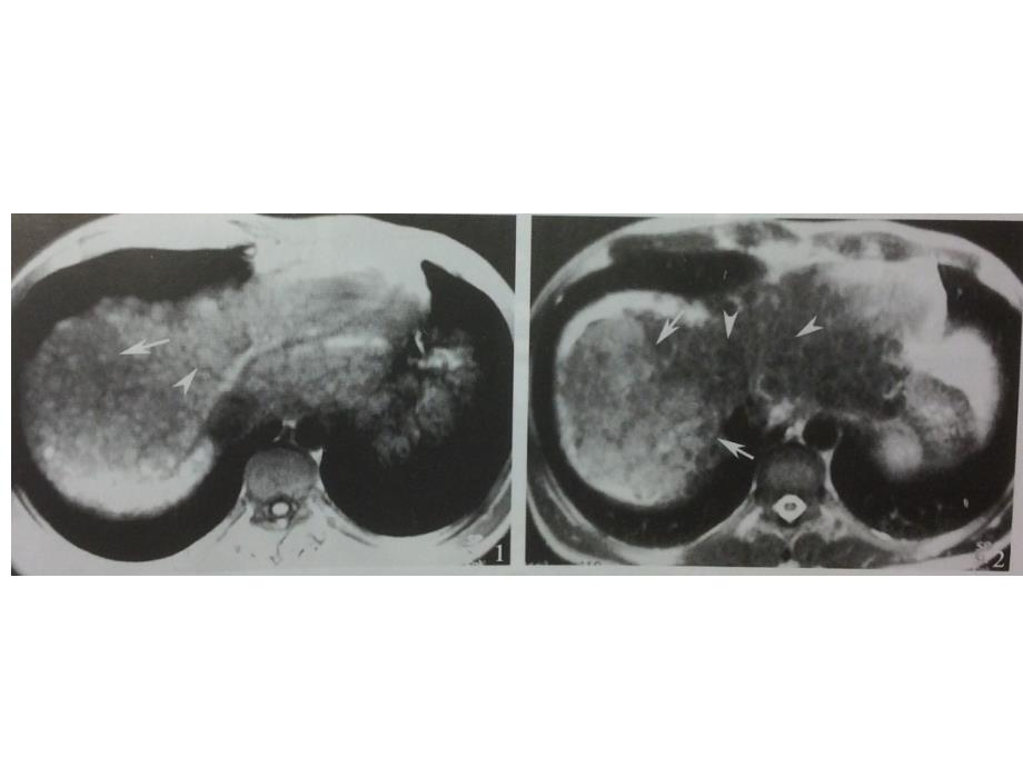 肝癌影像学鉴别诊断_第4页