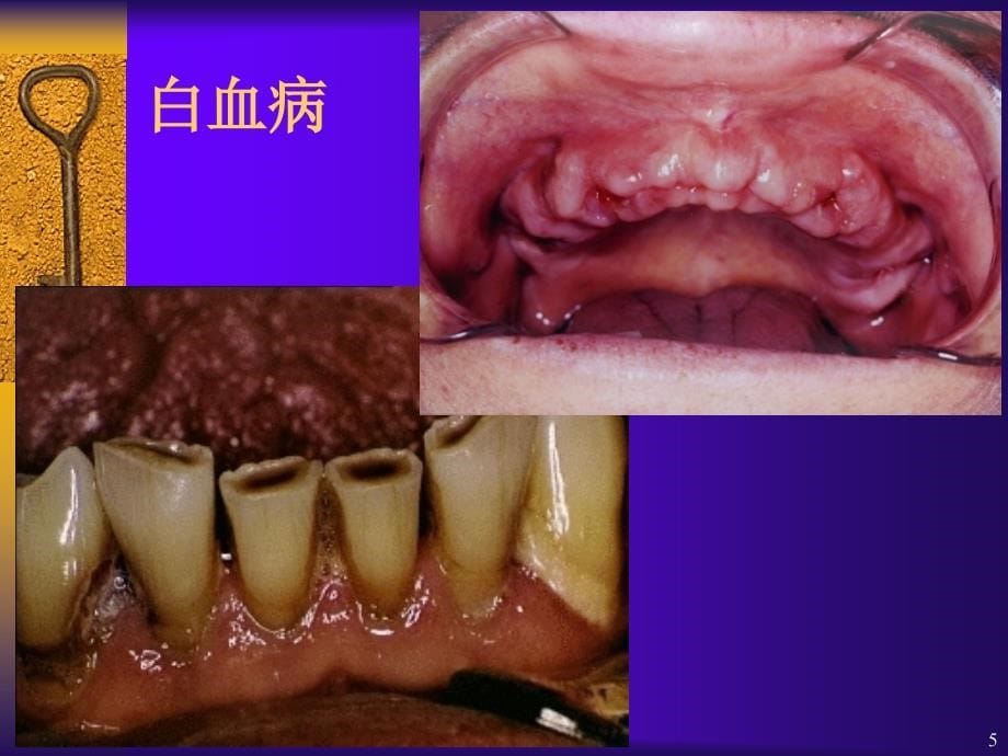 第十七章全身系统性疾病在口腔的表现课件_第5页