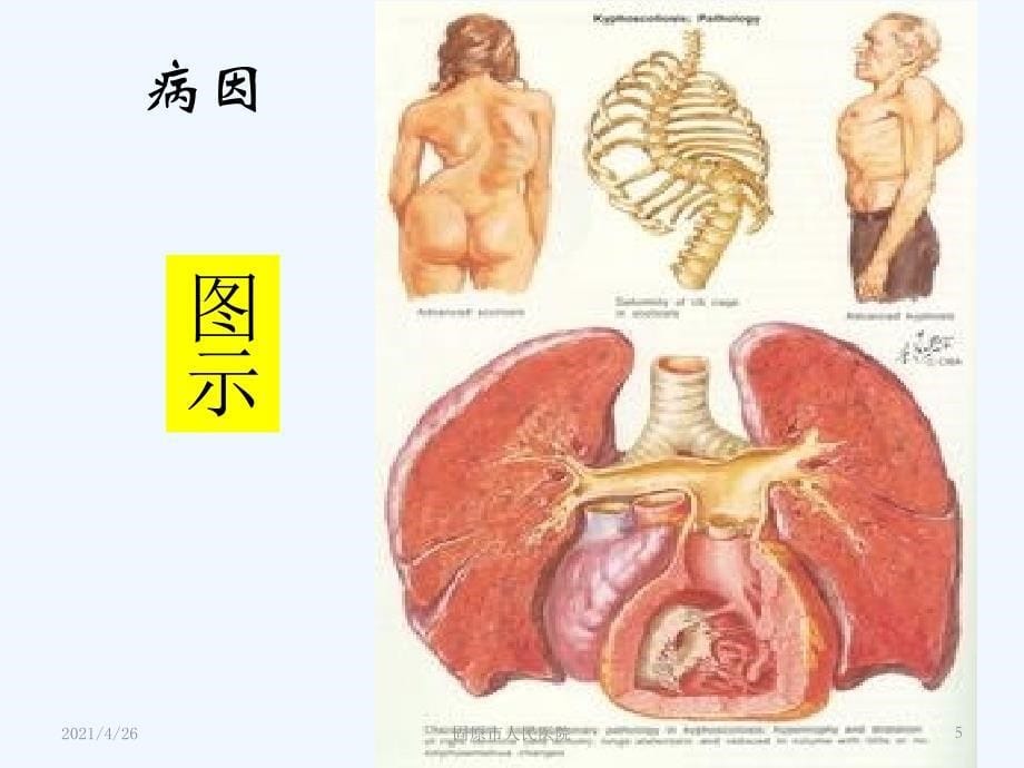 慢性肺源性心脏病精品课件_第5页