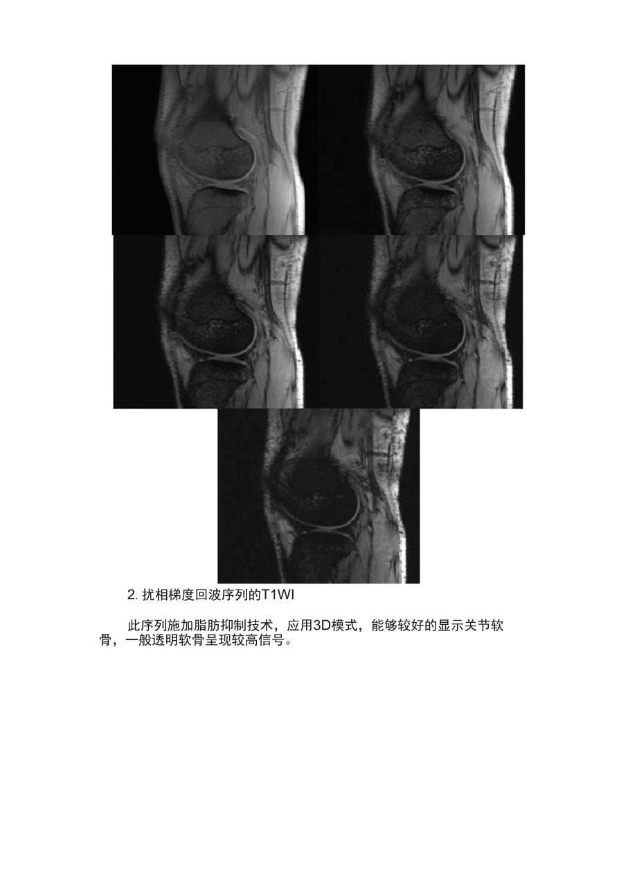 膝关节的MRI检查技术_第5页