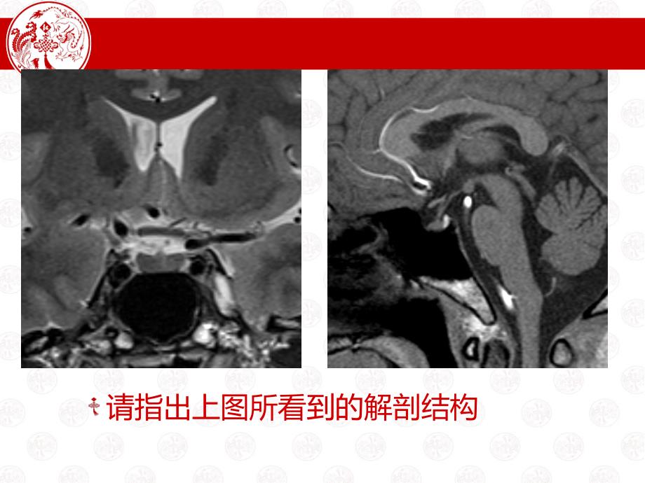 垂体微腺瘤课件_第1页