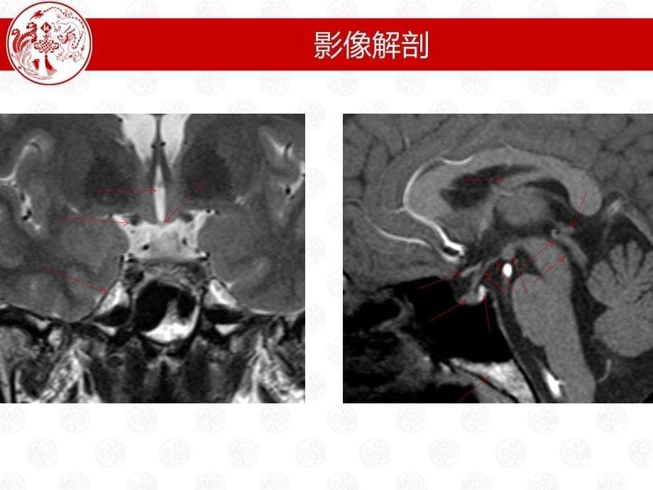 垂体微腺瘤课件_第5页