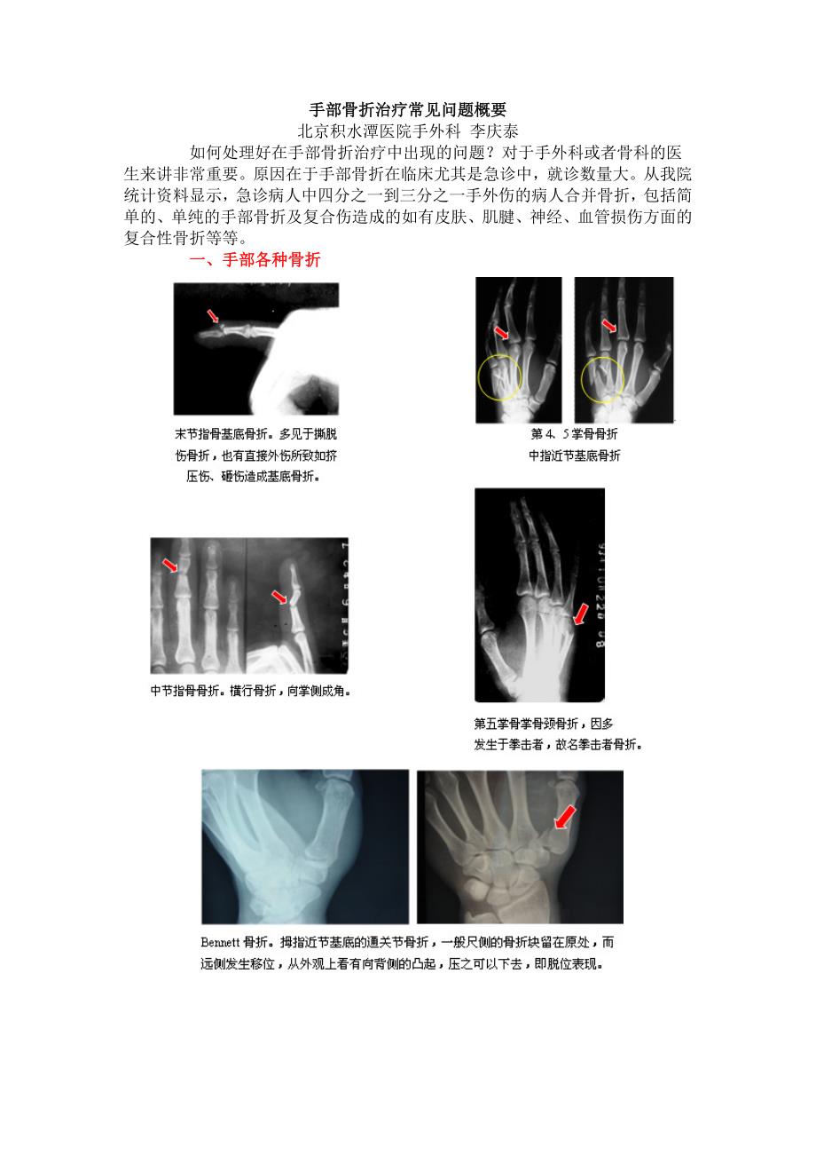 手部骨折治疗常见问题概要.doc_第1页