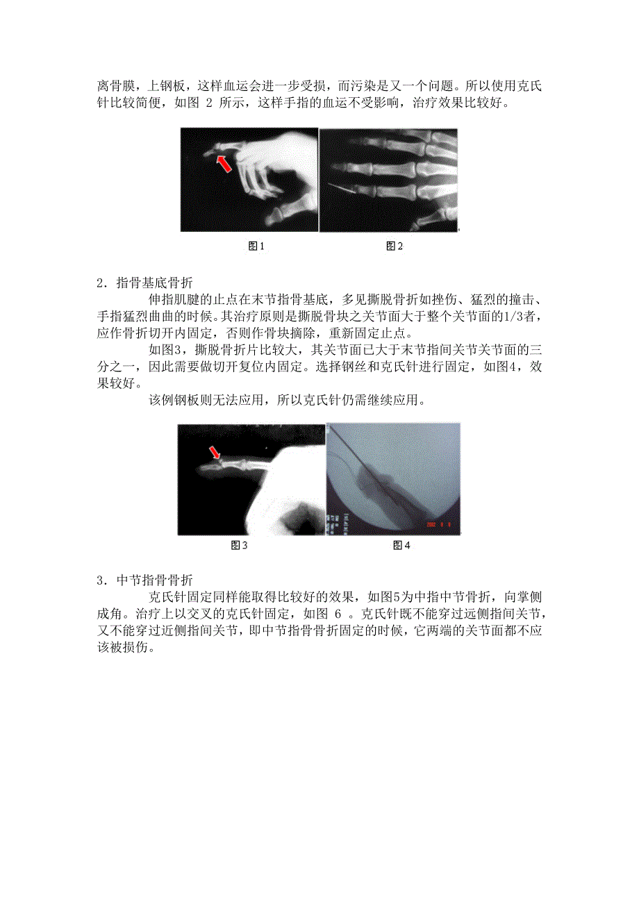 手部骨折治疗常见问题概要.doc_第4页