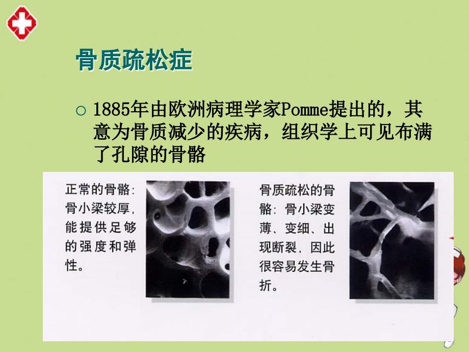 骨密度X线检查精编ppt_第3页