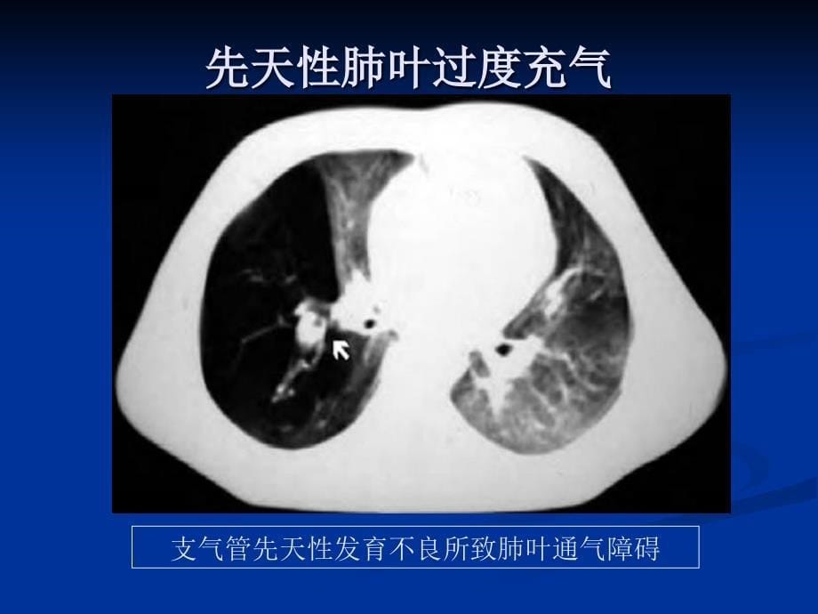 肺部先天发育异常影像_第5页