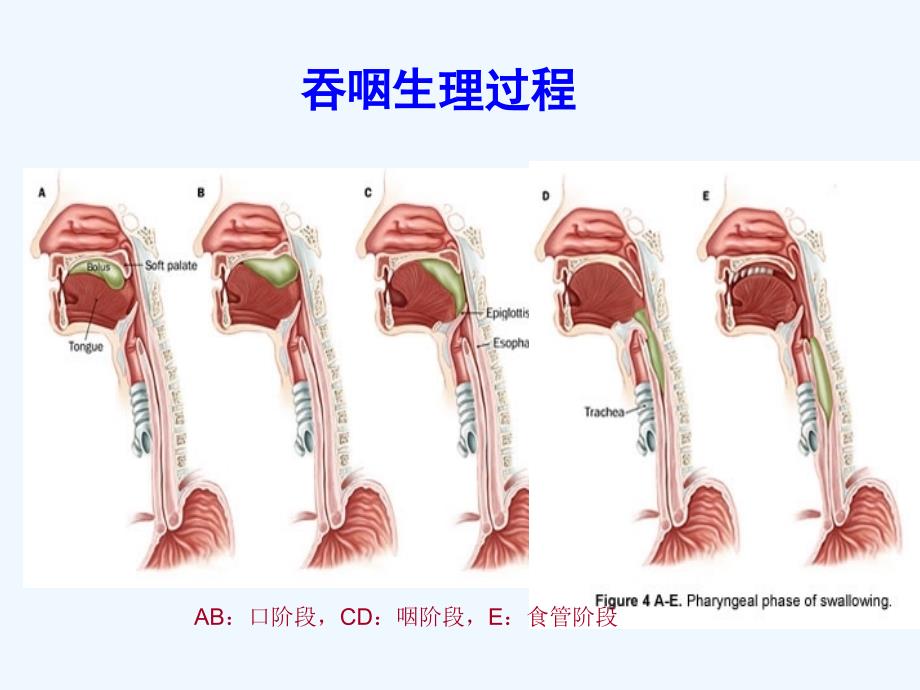 吞咽障碍康复护理课件_第4页