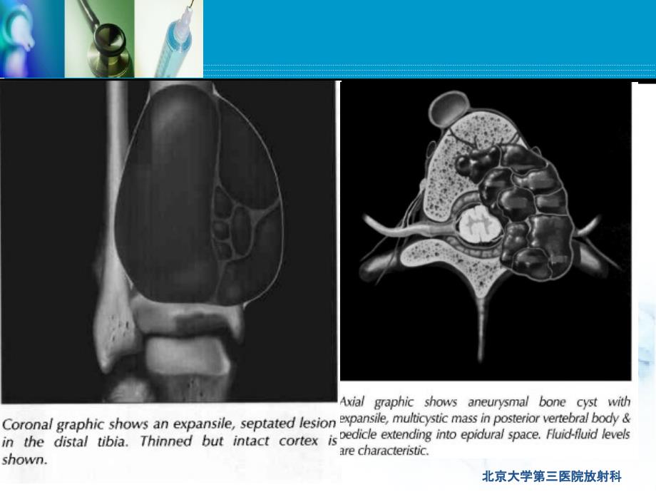 动脉瘤样骨囊肿_第3页