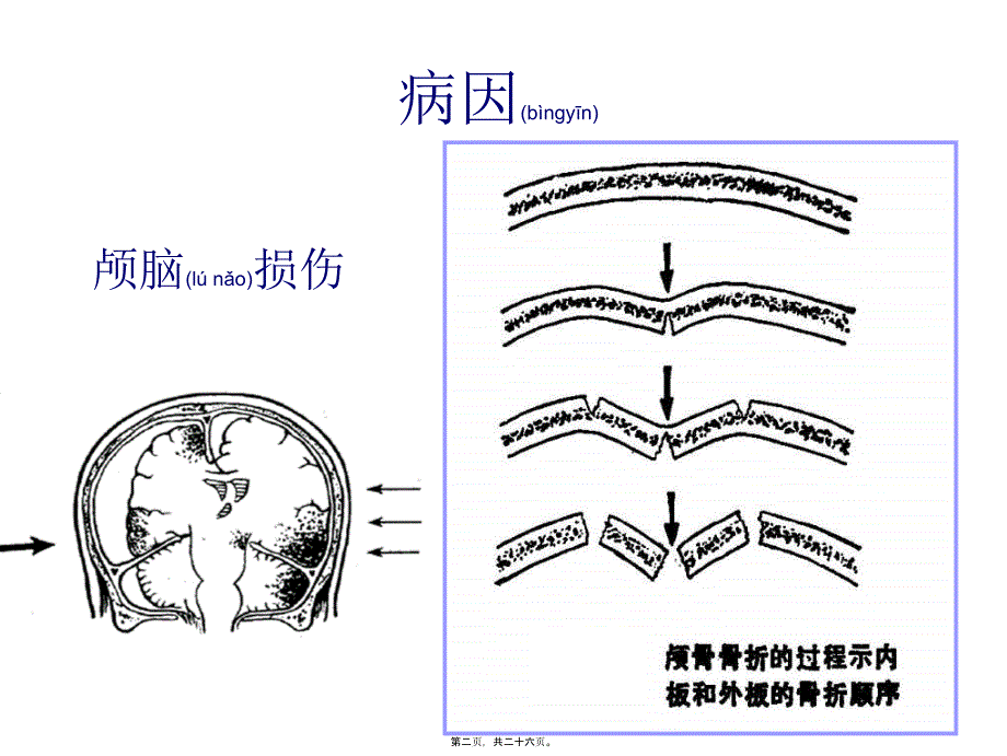 医学专题—硬膜外血肿_第2页