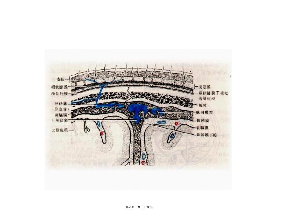 医学专题—硬膜外血肿_第4页