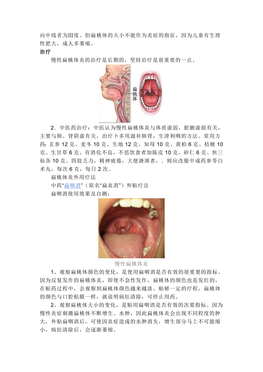 慢性扁桃体炎.doc_第2页