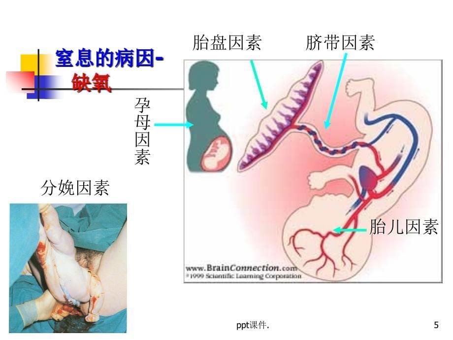 儿科新生儿窒息ppt课件_第5页