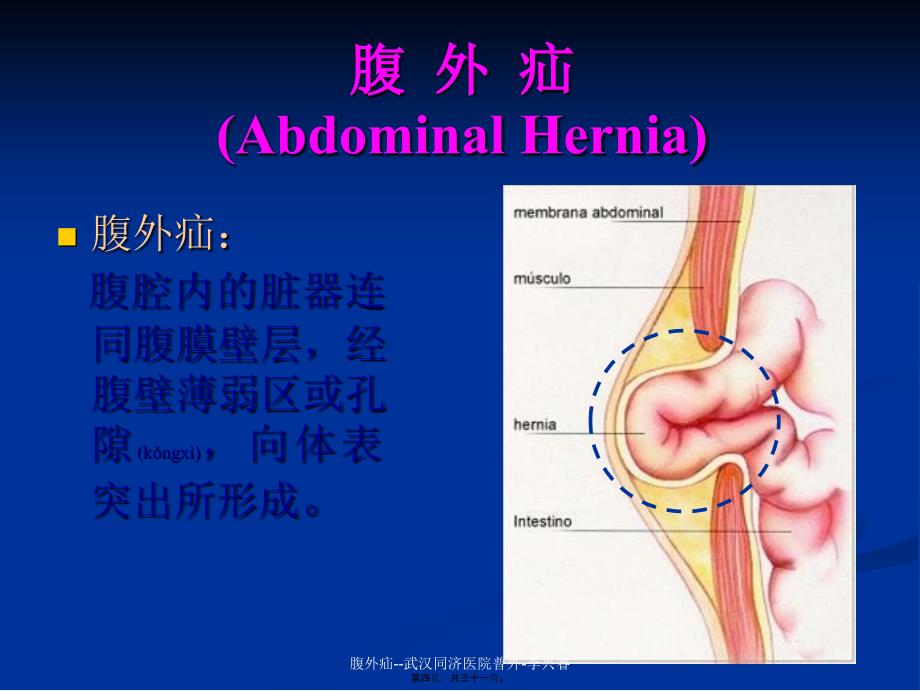 腹外疝武汉同济医院普外李兴睿课件_第4页