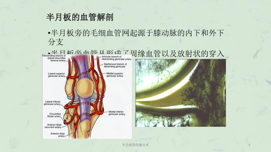 半月板损伤缝合术课件_第4页