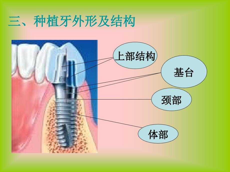 种植体周围炎动物模型建立_第4页