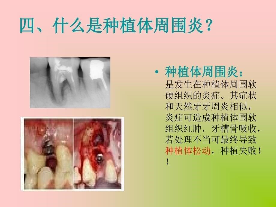 种植体周围炎动物模型建立_第5页