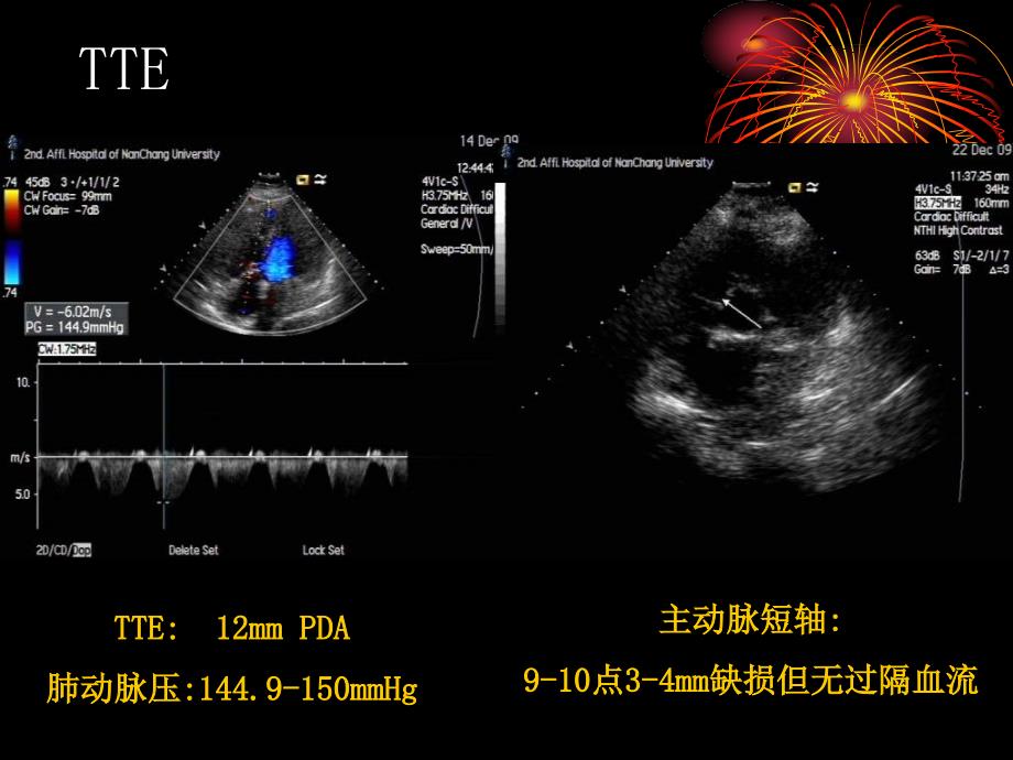 合并重度肺动脉高压动脉导管未闭介入治疗_第3页