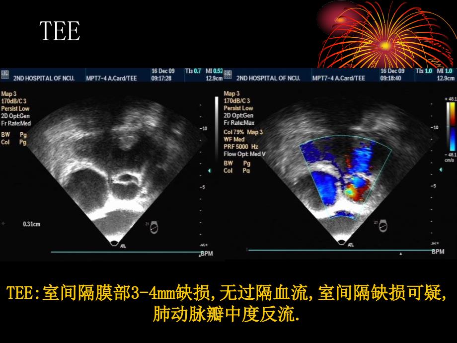 合并重度肺动脉高压动脉导管未闭介入治疗_第4页