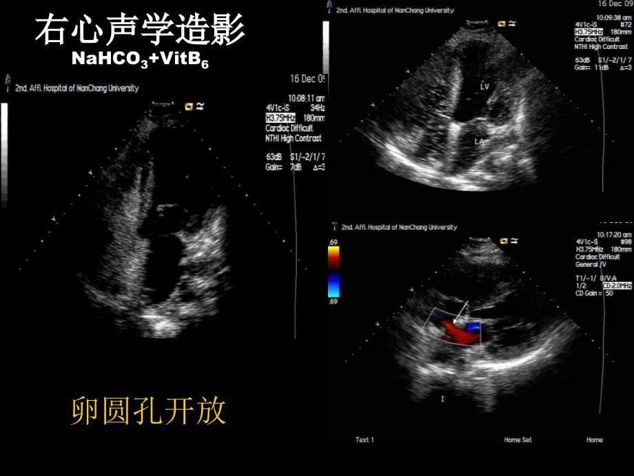 合并重度肺动脉高压动脉导管未闭介入治疗_第5页