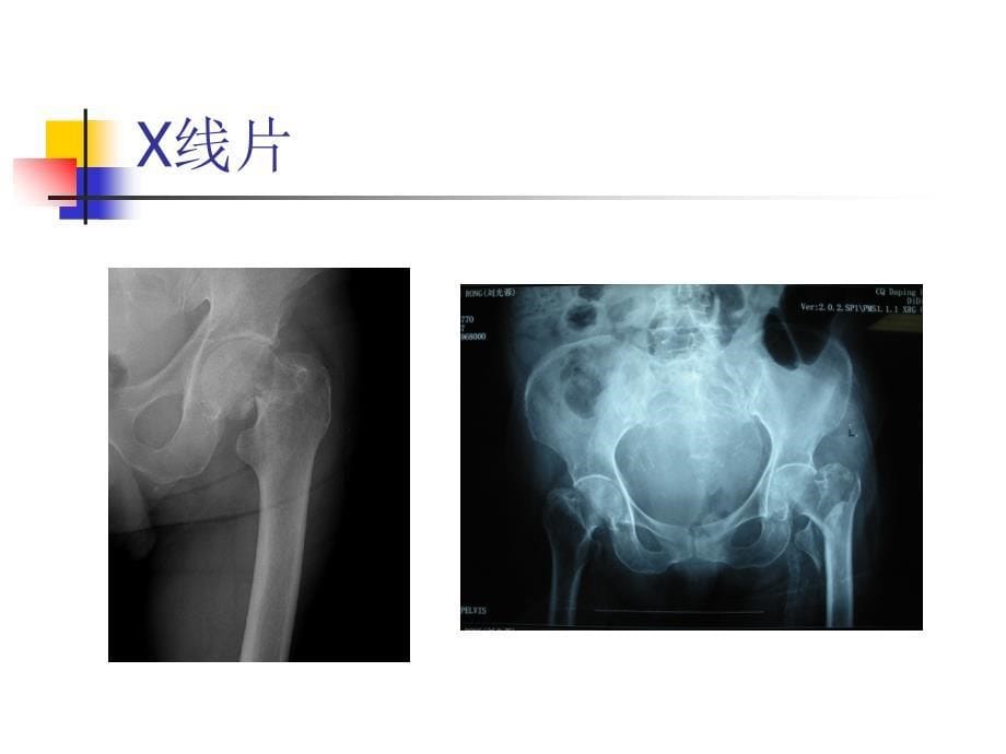 老年髋部骨折(股骨颈骨折,股骨转子间骨折课件)_第5页