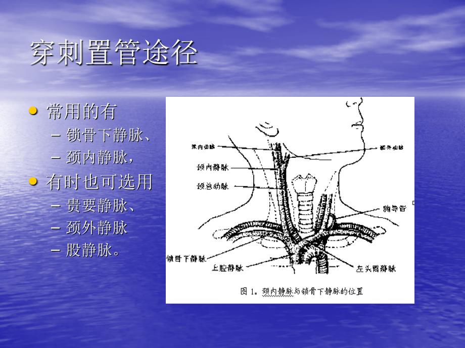 医学专题：锁骨下静脉穿刺jmcczgjsdlcyy_第3页