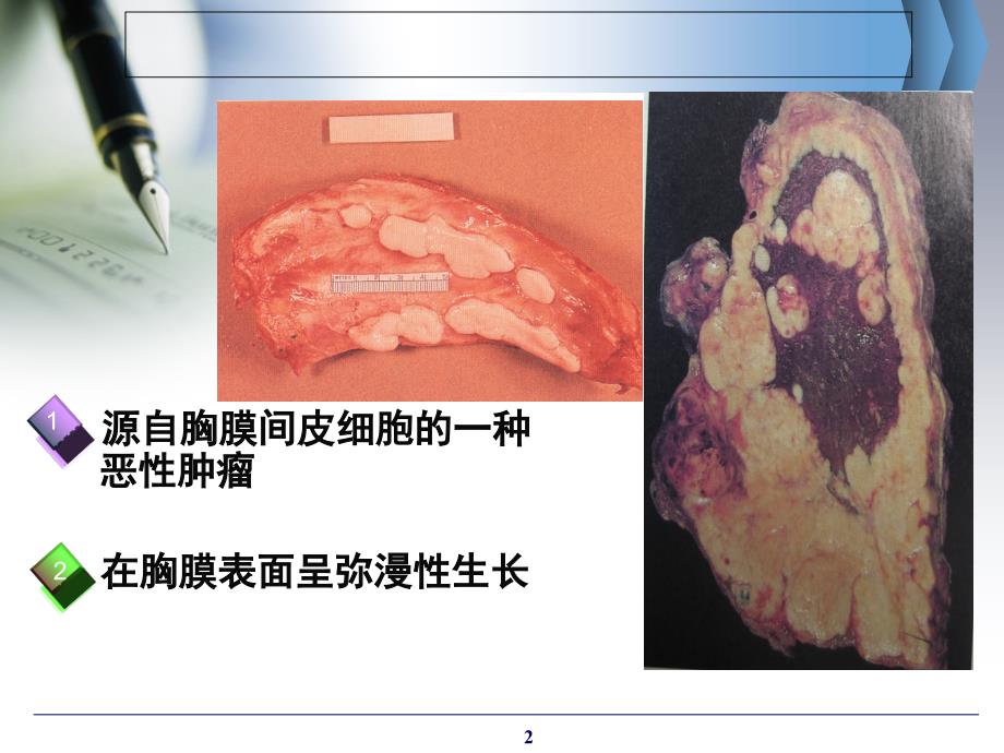 胸膜间皮瘤的诊治新进展PPT课件_第2页