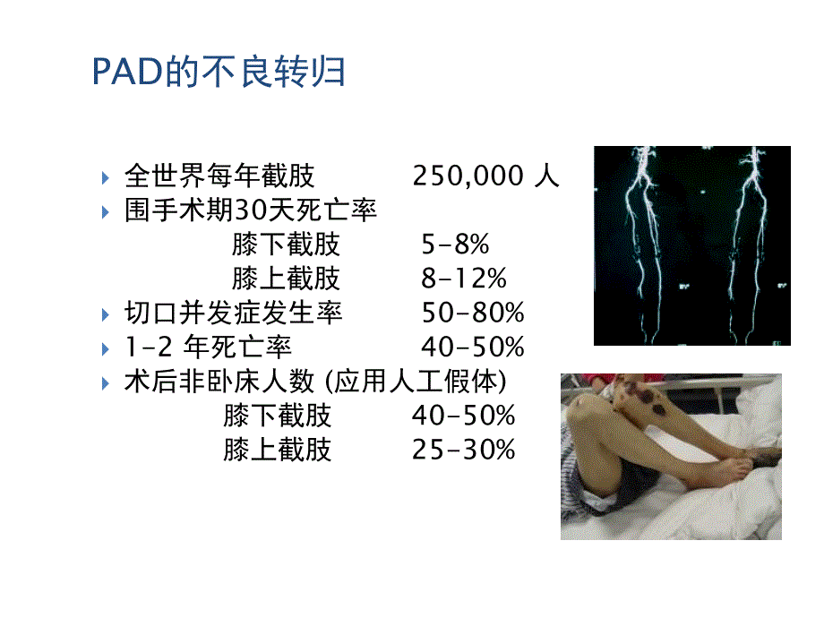 下肢脉硬化的药物治疗新选择安步乐克_第4页