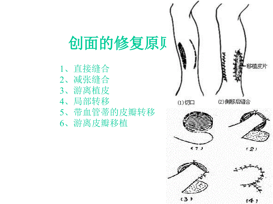 小腿皮肤缺损的修复共49张课件_第2页