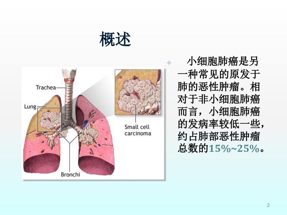 小细胞肺癌ppt课件_第2页