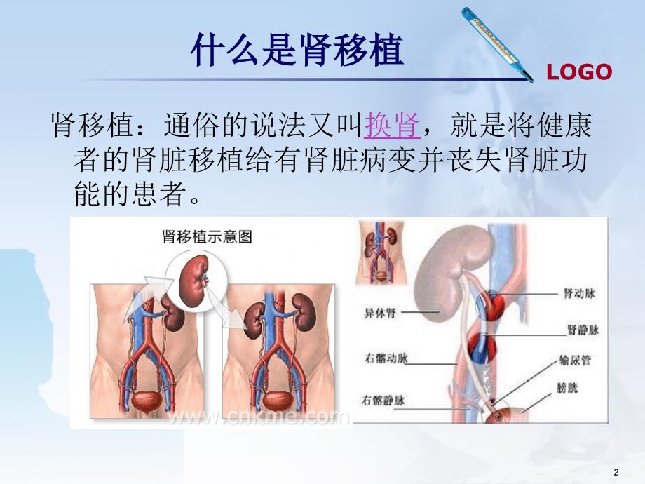 肾移植术后并发肺部感染护理查房ppt课件_第2页