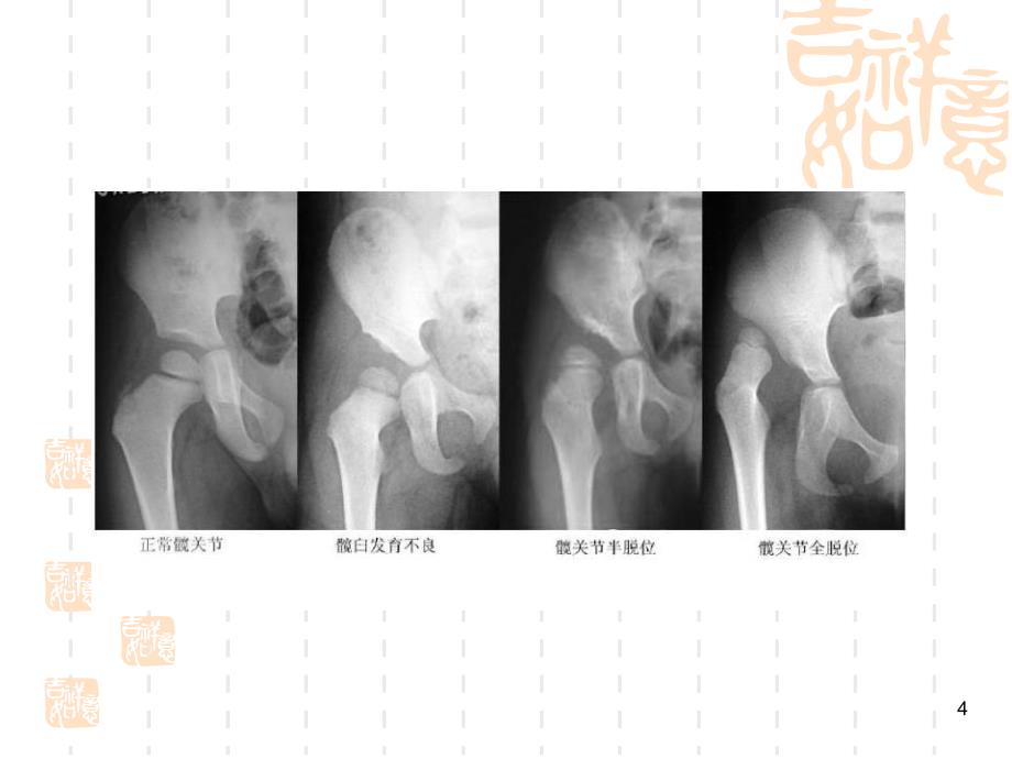 发育性髋关节发育不良DDHPPT课件_第4页